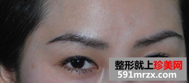 自体毛发无痕植眉前后效果对比图和恢复过程