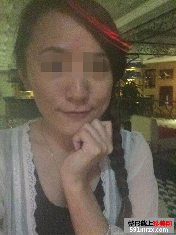 【内窥镜除皱去鱼尾纹前后对比效果图片和恢复过程】