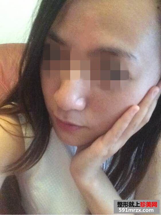 【内窥镜除皱去鱼尾纹前后对比效果图片和恢复过程】