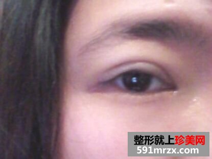 埋线双眼皮恢复超自然 过程图+恢复图