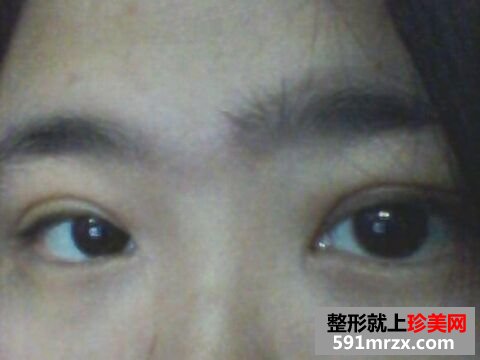 埋线双眼皮恢复超自然 过程图+恢复图