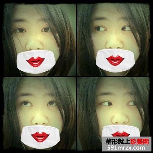 埋线双眼皮恢复超自然 过程图+恢复图