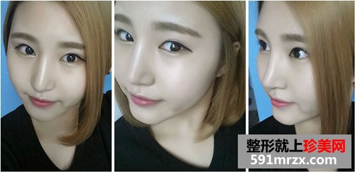 v-line四方脸整形术+立体开眼角前后效果对比图和恢复过程
