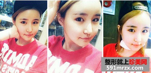 v-line四方脸整形术+立体开眼角前后效果对比图和恢复过程