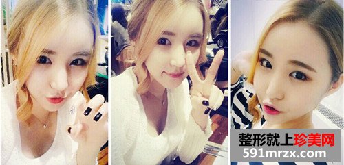 v-line四方脸整形术+立体开眼角前后效果对比图和恢复过程