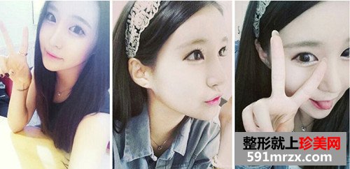 v-line四方脸整形术+立体开眼角前后效果对比图和恢复过程