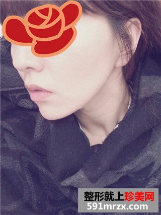 线雕面部提升术去法令纹前后对比效果图片和恢复过程