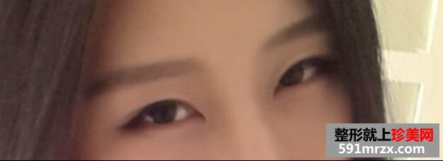 全切双眼皮让我内双变大眼睛 顺便分享消肿小妙招
