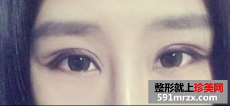 全切双眼皮让我内双变大眼睛 顺便分享消肿小妙招