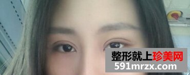 全切双眼皮让我内双变大眼睛 顺便分享消肿小妙招