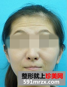 面部内窥镜去除抬头纹前后对比效果图片和恢复过程