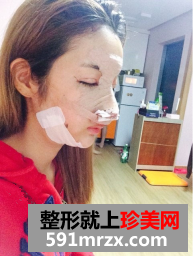 自体脂肪面部填充恢复术后恢复日记