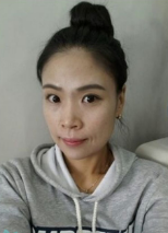 眼鼻综合+下颌角整形对比照片