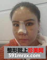 眼鼻综合+下颌角整形对比照片