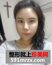 眼鼻综合+下颌角整形对比照片