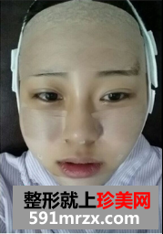 面部脂肪填充网友真实经历