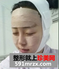 面部脂肪填充网友真实经历