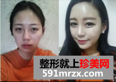 面部脂肪填充网友真实经历