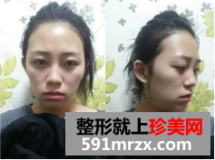 面部脂肪填充网友真实经历