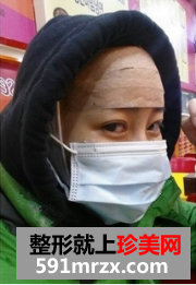 面部脂肪填充网友真实经历