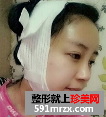 面部脂肪填充网友真实经历