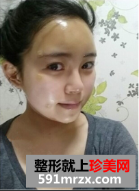 面部脂肪填充网友真实经历