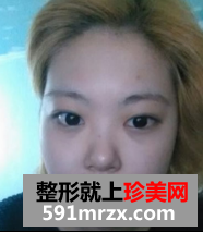 面部吸脂+综合隆鼻真实案例分享