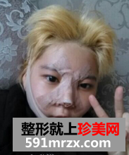 面部吸脂+综合隆鼻真实案例分享