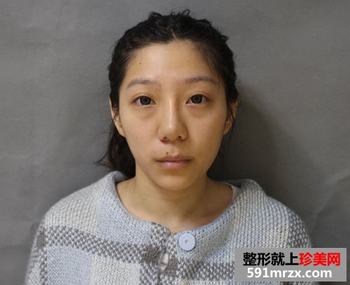 上海华美脂肪填充