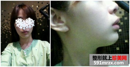 面部轮廓修复真人案例效果对比图