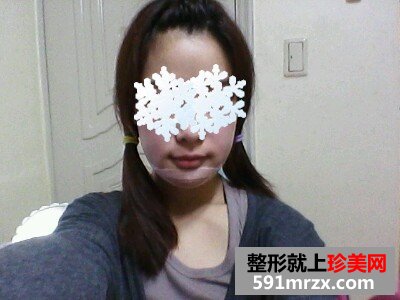 轮廓修复手术
