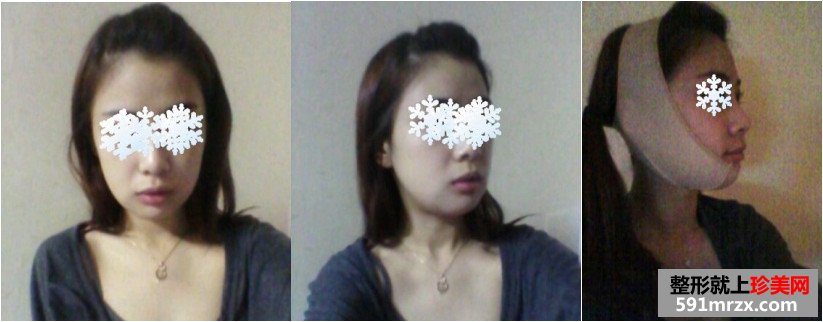轮廓修复手术