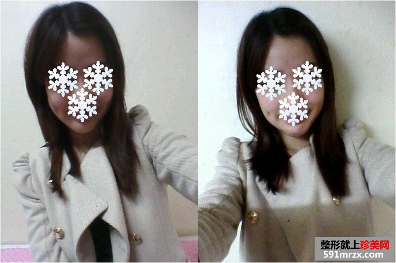 面部轮廓修复真人案例效果对比图