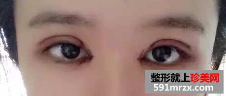 开眼角加双眼皮后 我变身萌妹纸一枚！