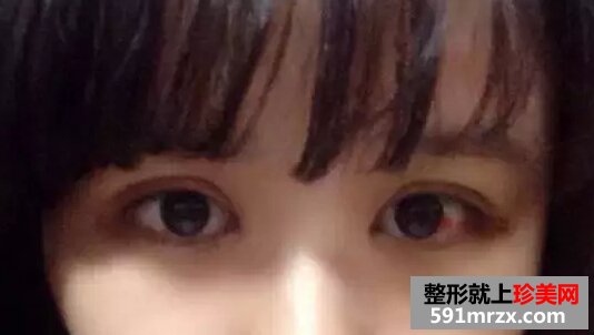 开眼角加双眼皮后 我变身萌妹纸一枚！