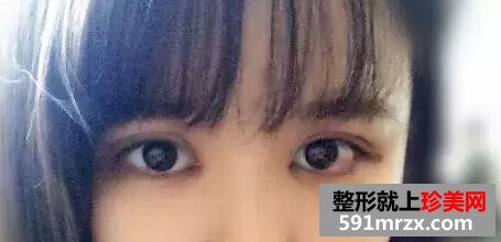 开眼角加双眼皮后 我变身萌妹纸一枚！