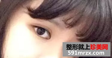 开眼角加双眼皮后 我变身萌妹纸一枚！