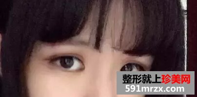 开眼角加双眼皮后 我变身萌妹纸一枚！