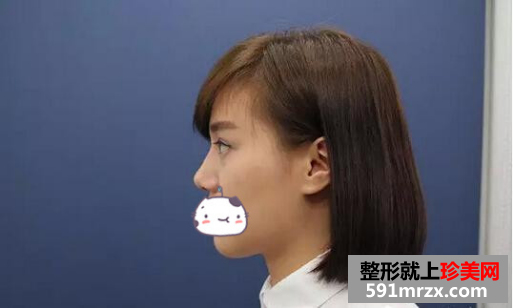 玻尿酸隆鼻真人案例对比图