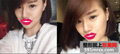 玻尿酸隆鼻真人案例对比图