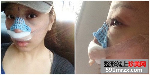鼻中隔软骨隆鼻+鼻翼缩小术前后照片对比和恢复过程