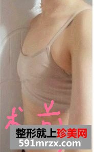 300cc高凝聚性硅胶假体隆胸手术前后对比效果图片分享