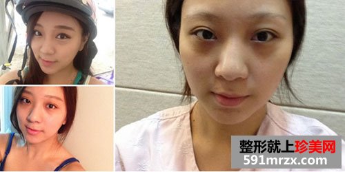 鼻中隔软骨隆鼻+鼻翼缩小术前后照片对比和恢复过程