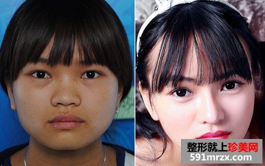 美国曼托假体隆胸手术前后对比效果照片和恢复过程350