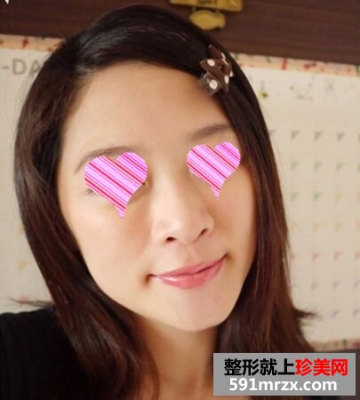 打了瘦脸针效果很明显 迅速变小脸