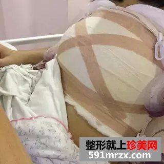 麦格琴面假体丰胸手术恢复过程分享，有前后对比效果照片哟！