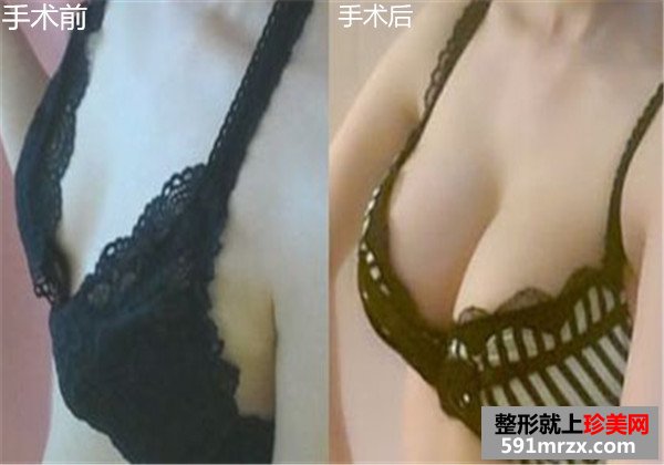 自体脂肪活细胞丰胸手术前后效果对比图片和恢复过程分享