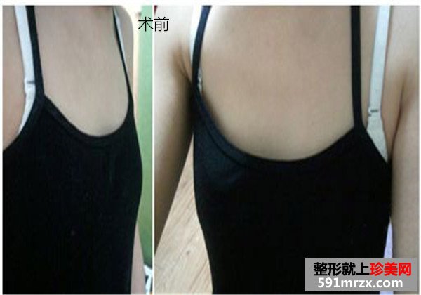 自体脂肪活细胞丰胸手术前后效果对比图片和恢复过程分享