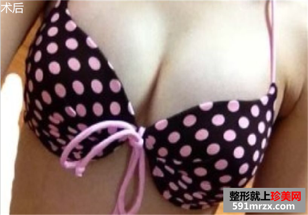 自体脂肪活细胞丰胸手术前后效果对比图片和恢复过程分享