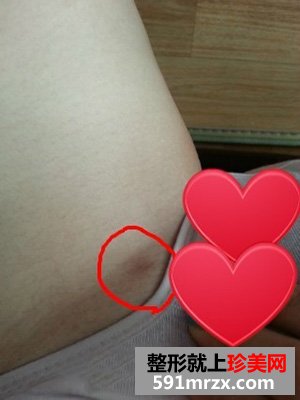 大腿吸脂整形手术前后对比效果照片分享，还有恢复过程哦！
